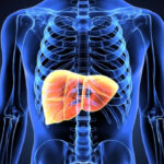 Sobrepeso y obesidad: principales factores de riesgo relacionados al desarrollo de esteatohepatitis asociada a disfunción metabólica