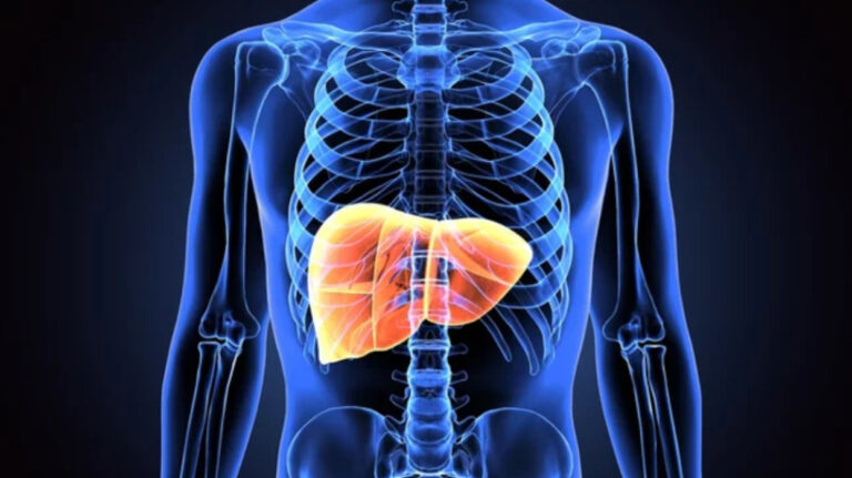 Sobrepeso y obesidad: principales factores de riesgo relacionados al desarrollo de esteatohepatitis asociada a disfunción metabólica