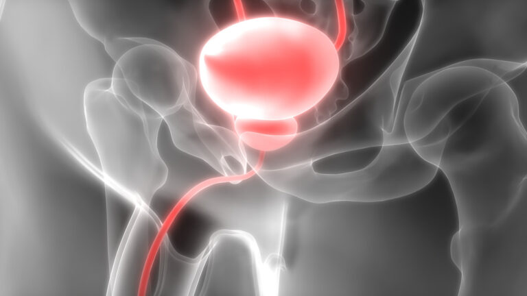 Síntomas de cáncer de próstata: señales que muchos hombres ignoran hasta etapas avanzadas
